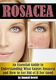 Rosacea: An Essential Guide to Understanding What Causes Rosacea and How to Get Rid of It For Good